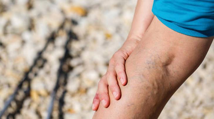 varices dos