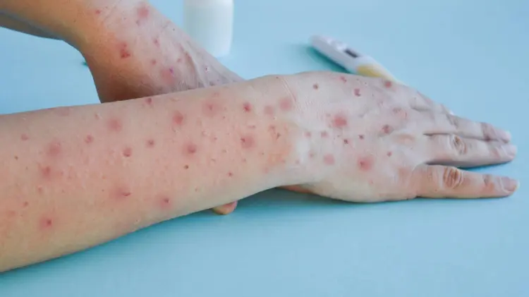 Seguirá la vigilancia epidemiológica para detectar casos de viruela símica en la entidad. (Especial)