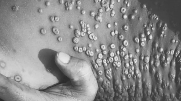 MC llama al gobierno a garantizar atención por viruela del mono