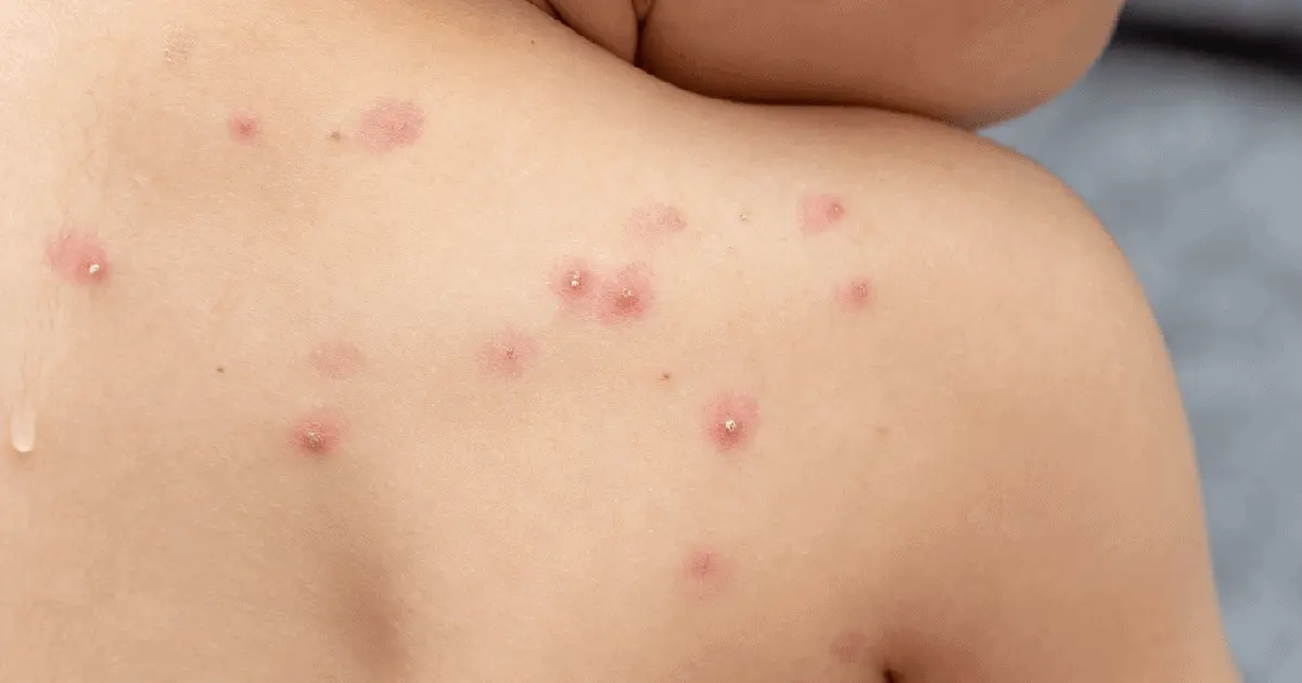 México contabiliza 252 contagios de Viruela del Mono