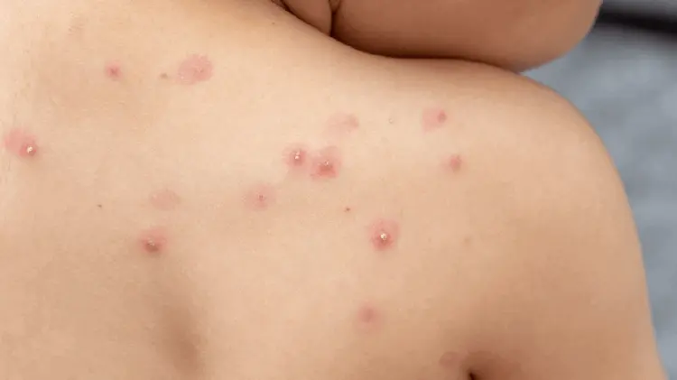 Viruela símica no se propagará como el Covid-19: López-Gatell