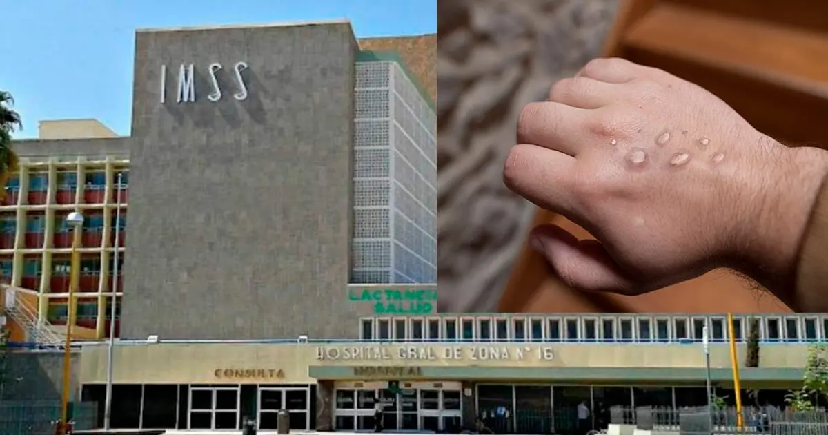 Nuevo caso de viruela del mono en niño de 3 años