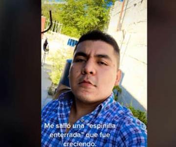 Pensaba que era un barro y terminó siendo un tumor