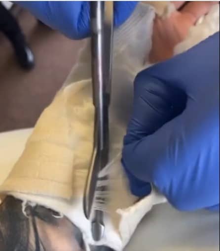 Cómo quedó la mano de Canelo Álvarez tras cirugía