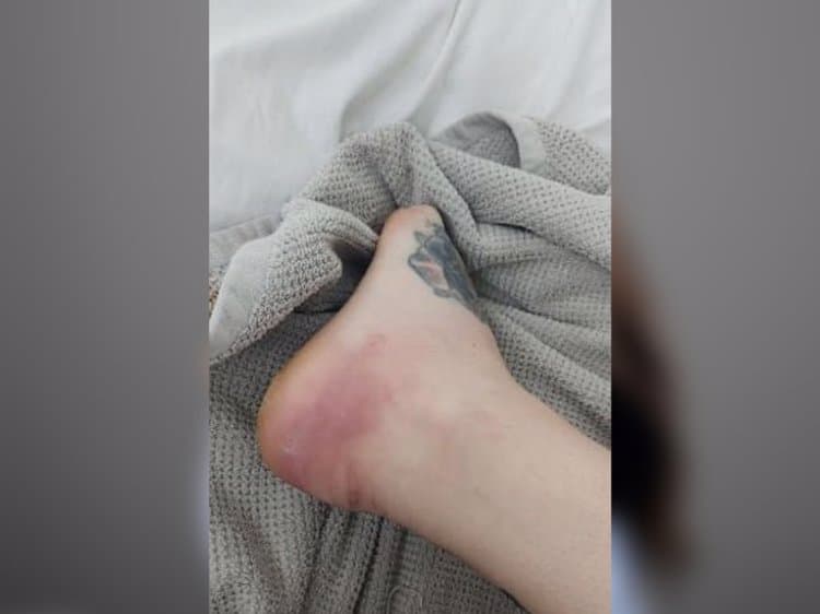 Le amputan la pierna a mujer por picadura de araña