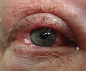 Incrementan casos de conjuntivitis en Sonora este año