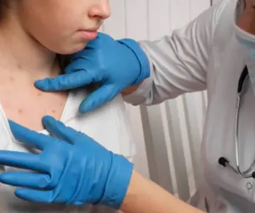 Emiten alerta sanitaria por sarampión para viajes a EU y Canadá