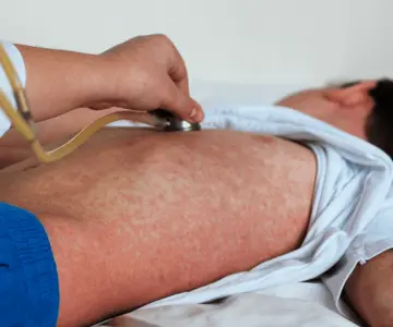Aumentan contagios de sarampión en Chihuahua; van 95 casos atendidos