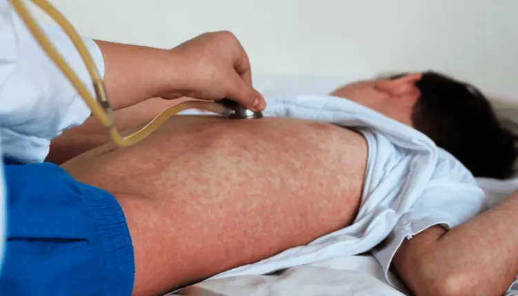 Reporta Secretaría de Salud mil 926 casos de sarampión en México