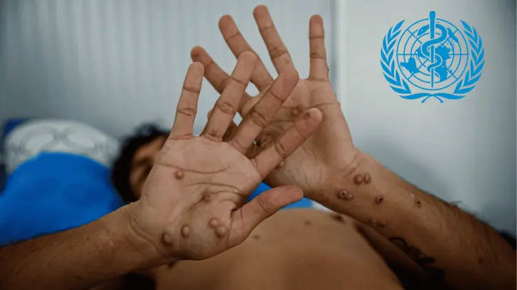 El brote en República Democrática del Congo se ha extendido a otros países. (Especial / EXPRESO)