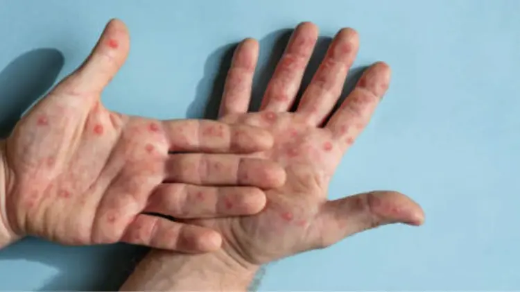 La Viruela del Mono puede contagiarse de diferentes maneras. (Foto: Cortesía)