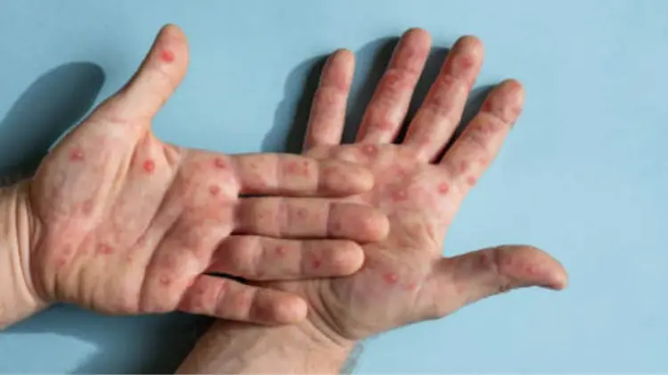 La OMS declaró emergencia mundial de salud por mpox este miércoles 14 de agosto. (Foto: Especial)