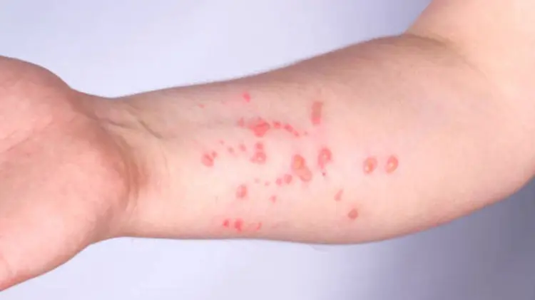 La viruela símica es generada por un virus que provoca erupciones dolorosas. (Foto: Especial)