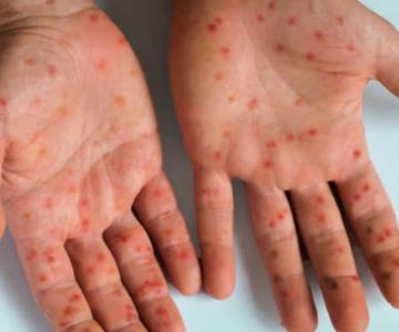 México aprueba vacuna ‘Jynneos’ contra la mpox para personas de alto riesgo