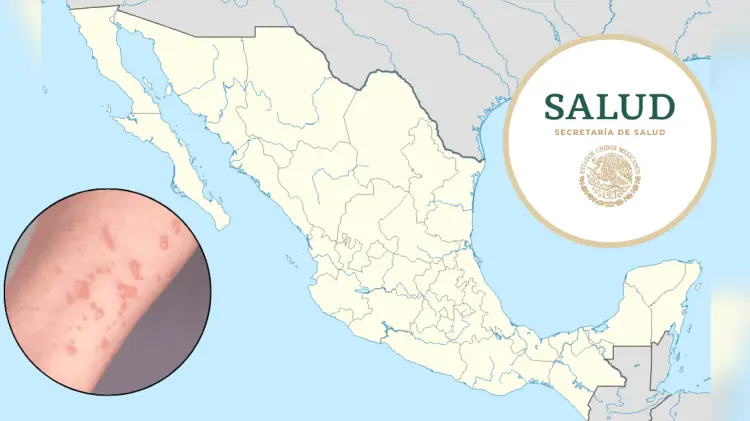 México acumula en lo que va de 2024 un total de 55 casos de Mpox. (Foto: Especial/EXPRESO)