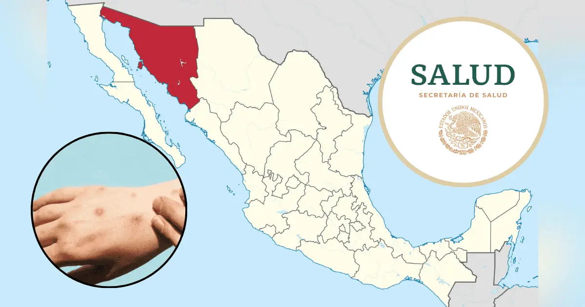 Ciudad de México y Sonora encabezan nuevos casos de viruela del mono