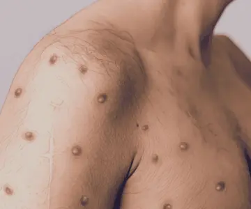 ¿Mpox podría desatar  una nueva pandemia?