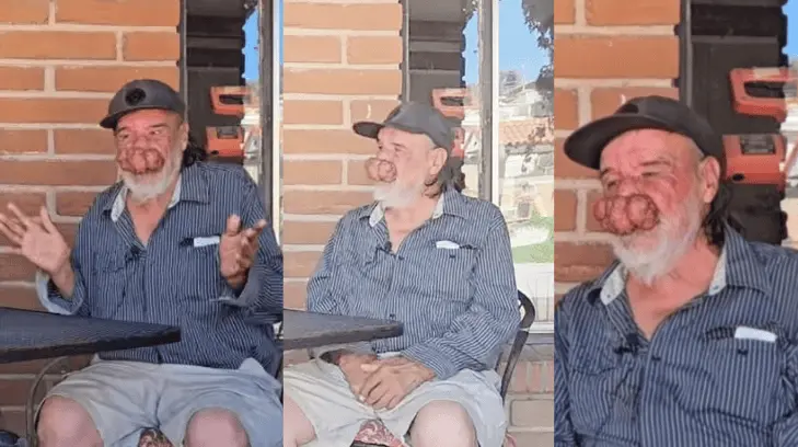 Los tumores, por su tamaño, podrían llegar a afectar la respiración.ESPECIAL/EXPRESO