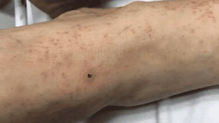 La Secretaría de Salud hizo un llamado a prevenir la enfermedad. (Especial / EXPRESO)