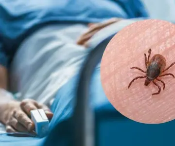 Sonora suma 18 muertes por rickettsia y 38 casos confirmados