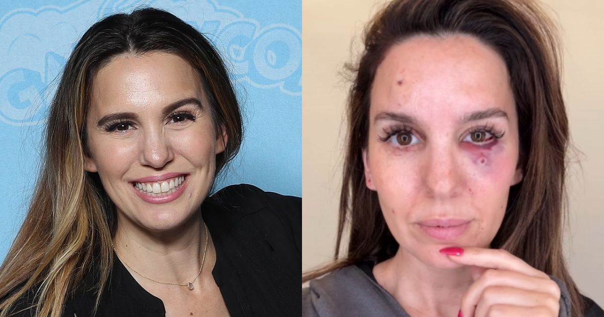Exactriz de Disney a punto de perder un ojo tras recibir disparo
