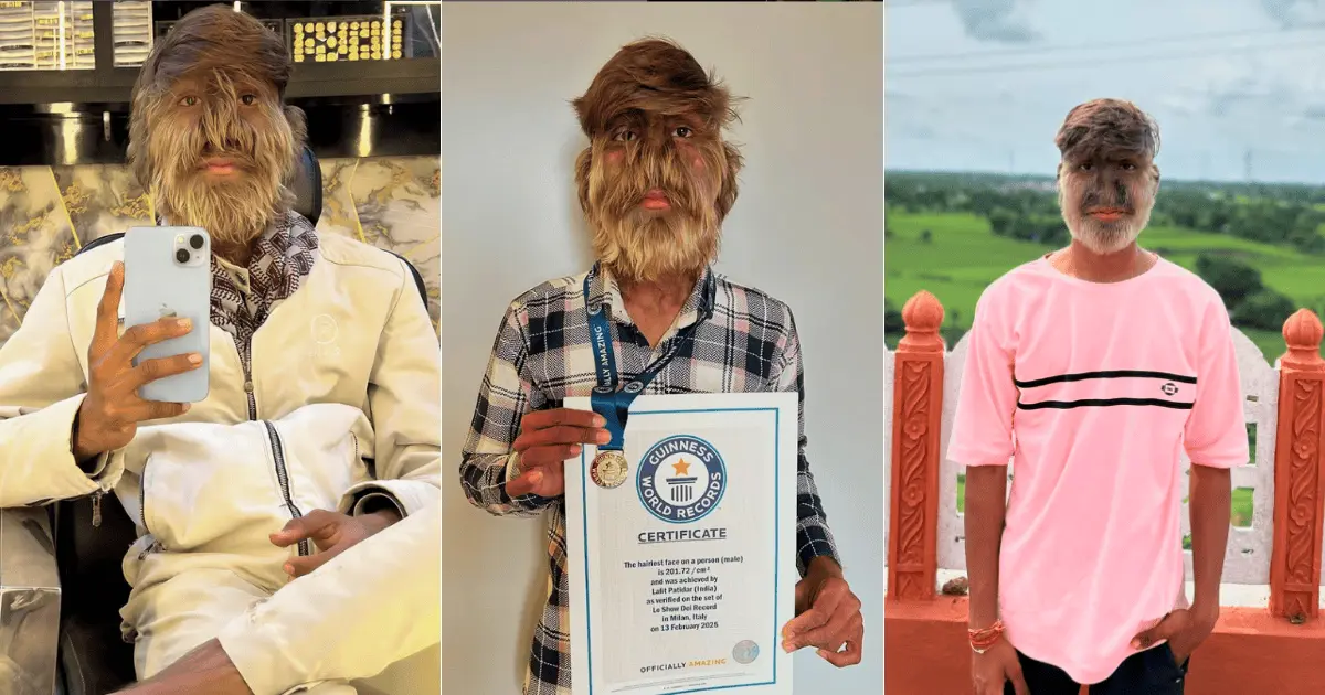 Joven con raro padecimiento gana Récord Guinness por la cara más peluda