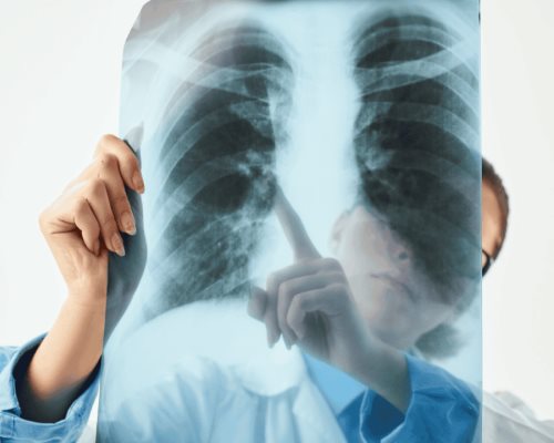 Veinte contagios de tuberculosis registra Sonora cada semana