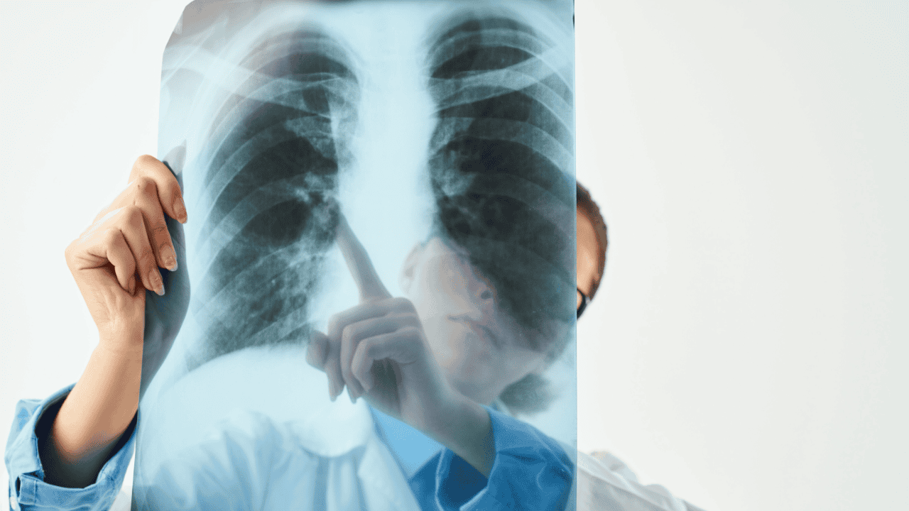 Veinte contagios de tuberculosis registra Sonora cada semana