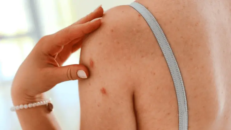 La Secretaría de Salud y el IMSS han iniciado acciones de control epidemiológico. (Foto: Especial)