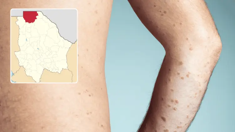 El hombre presentaba diabetes preexistente. (Foto: Especial/EXPRESO)