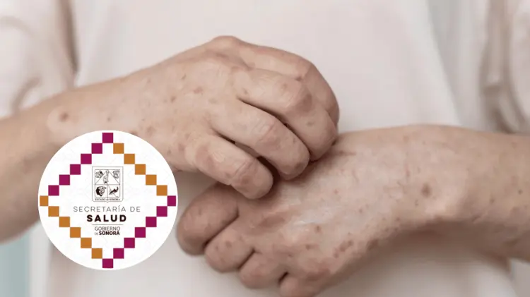 Los casos fueron identificados oportunamente, permitiendo aplicar medidas inmediatas de contención.