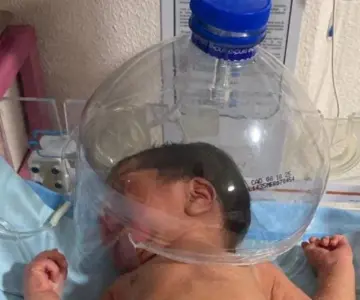 Médicos usan botella para salvar la vida de recién nacido en Tabasco