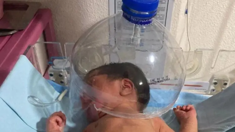 A falta equipo, hospital del IMSS usó botella de plástico para salvar vida a bebé en Tabasco.