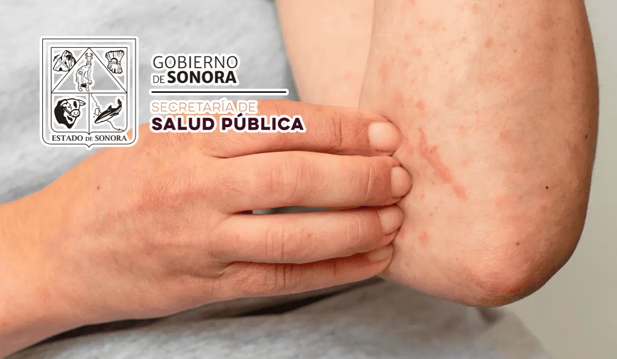 Fallece menor por sarampión en Sonora; autoridades llaman a la vacunación