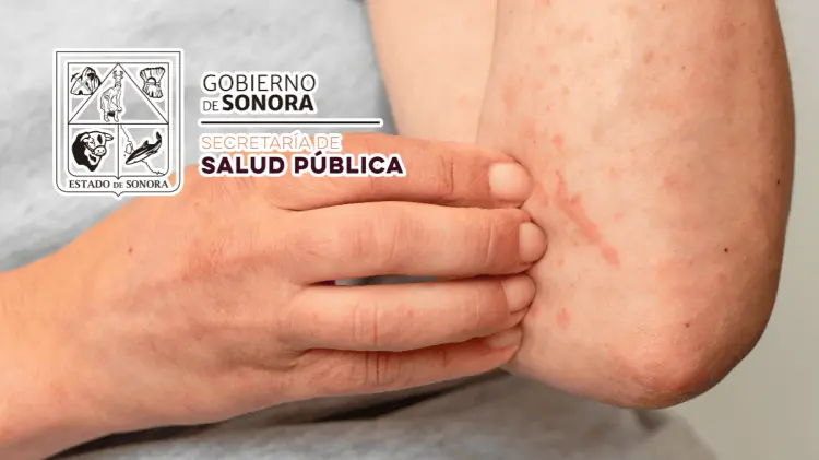 La SSP actualizó este martes la cifra de casos de sarampión. (Foto: Especial/EXPRESO)