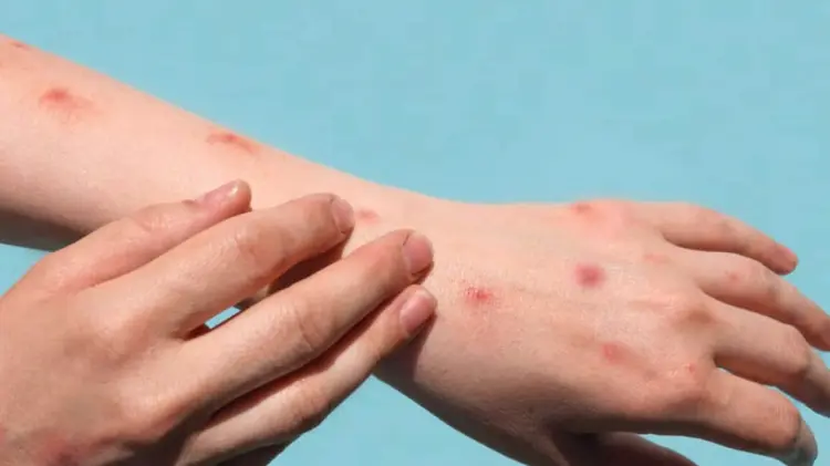Jalisco es la segunda entidad con más casos de Mpox. (Foto: Especial / EXPRESO)