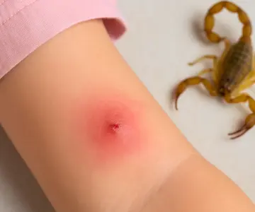 FGR asumirá investigación de muerte de niña picada por alacrán en Hermosillo