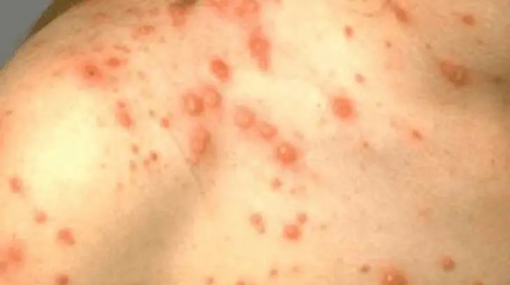 Ante la presencia de manchas en la piel, se debe acudir al hospital. (Foto: Especial/EXPRESO)