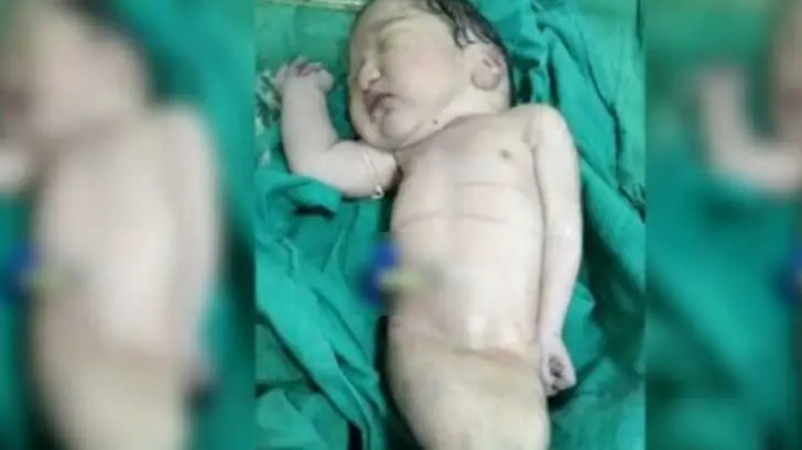 Muere bebé sirena cuatro horas después de nacer en India