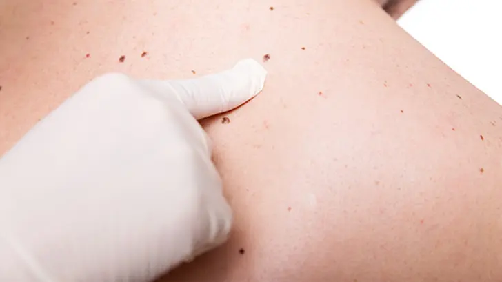 ¡Cuídate del cáncer de piel! Estos son los mejores bloqueadores solares