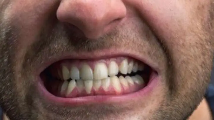 Rechinar los dientes puede provocar su pérdida prematura: IMSS