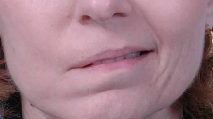 ¿Qué tan probable es tener una parálisis facial por cambios de temperatura?