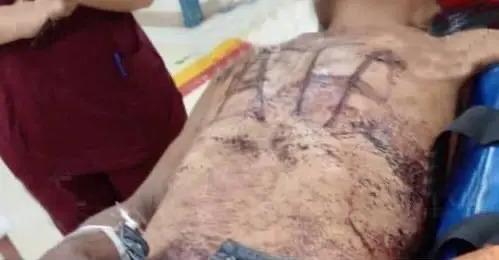 Increíble: con hierro caliente le marcan rata en el pecho a un hombre en Cajeme