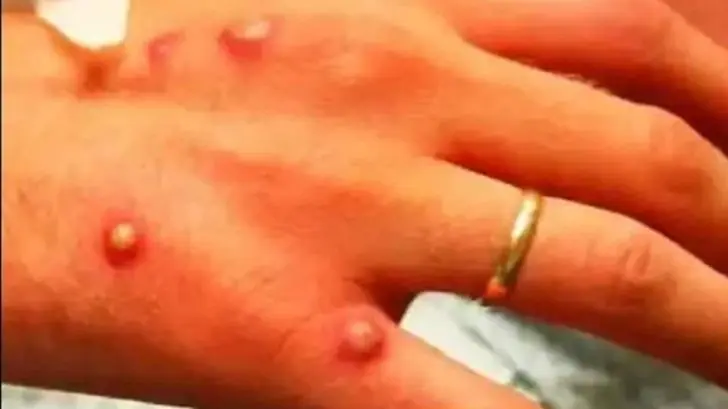 Dan de alta a sonorenses que se habían contagiado con la viruela del mono